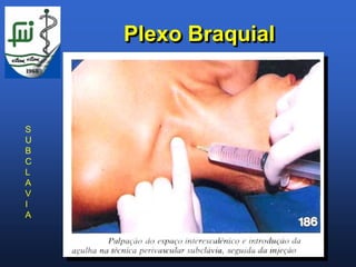 Plexo Braquial



S
U
B
C
L
A
V
I
A
 