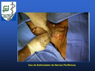Uso do Estimulador de Nervos Periféricos
 