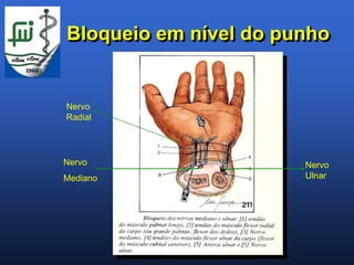 Bloqueio em nível do punho


Nervo
Radial




Nervo                  Nervo
Mediano                Ulnar
 