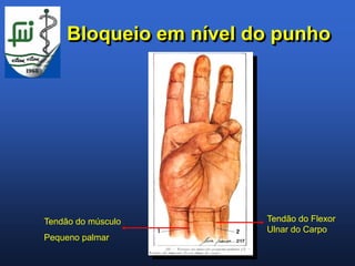 Bloqueio em nível do punho




Tendão do músculo       Tendão do Flexor
                        Ulnar do Carpo
Pequeno palmar
 