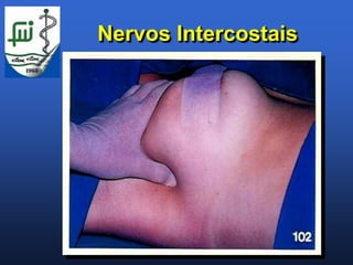 Nervos Intercostais
 
