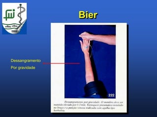 Bier



Dessangramento
Por gravidade
 