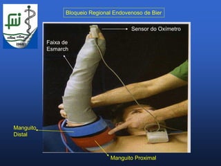 Bloqueio Regional Endovenoso de Bier

                                          Sensor do Oxímetro

           Faixa de
           Esmarch




Manguito
Distal



                                  Manguito Proximal
 