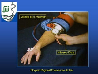 Desinfla-se o Proximal




                               Infla-se o Distal




         Bloqueio Regional Endovenoso de Bier
 