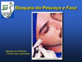 Bloqueio do Pescoço e Face




Bloqueio do N Maxilar
Técnica Supra zigomática
 