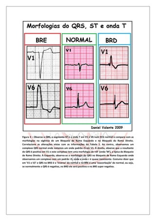 Figura 3 – Observe o QRS, o segmento ST e a onda T em V1 e V6 num ECG normal e compare com as
morfologias na vigência de um Bloqueio de Ramo Esquerdo e no Bloqueio do Ramo Direito.
Correlacione as alterações vistas com as informações da Tabela 1. Ao centro, observamos um
complexo QRS normal onde notamos um onda padrão rS em V1. Á direita, observe que a resultante
do QRS é positiva em V1 e este complexo tem uma morfologia de rsR' (onda ‘M’), a típica do Bloqueio
de Ramo Direito. À Esquerda, observa-se a morfologia do QRS no Bloqueio de Ramo Esquerdo onde
observamos um complexo com um padrão rS, onde a onda r é quase inexistente. Costumo dizer que
em ‘V1 e V2’ o QRS no BRD é o ‘inverso’ do normal e no BRE é uma ‘exacerbação’ do normal, ou seja,
se normalmente o QRS é negativo, no BRD ele será positivo e no BRE super negativo.
 