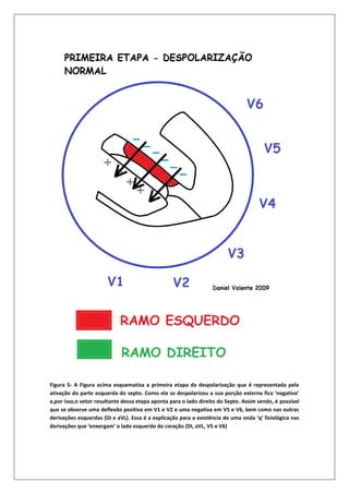 Figura 5- A Figura acima esquematiza a primeira etapa da despolarização que é representada pela
ativação da parte esquerda do septo. Como ela se despolarizou a sua porção externa fica ‘negativa’
e,por isso,o vetor resultante dessa etapa aponta para o lado direito do Septo. Assim sendo, é possível
que se observe uma deflexão positiva em V1 e V2 e uma negativa em V5 e V6, bem como nas outras
derivações esquerdas (DI e aVL). Essa é a explicação para a existência de uma onda ‘q’ fisiológica nas
derivações que ‘enxergam’ o lado esquerdo do coração (DI, aVL, V5 e V6)
 