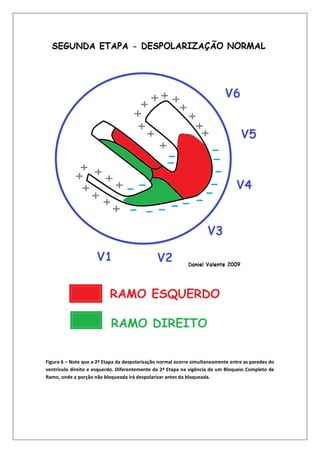 Figura 6 – Note que a 2ª Etapa da despolarização normal ocorre simultaneamente entre as paredes do
ventrículo direito e esquerdo. Diferentemente da 2ª Etapa na vigência de um Bloqueio Completo de
Ramo, onde a porção não bloqueada irá despolarizar antes da bloqueada.
 