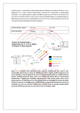 justificará,assim, a alteração da repolarização típica dos Bloqueios Completos de Ramo. Ora, o
segmento ST e a onda T (juntos denominados ‘intervalo ST’), representam a repolarização
miocárdica. Se a repolarização na vigência do BRE irá apontar para Frente e Para direita e ela
irá ocorrer ao mesmo tempo em que ocorre o final da despolarização ( ver Despolarização no
BRD, logo acima) haverá uma ‘supralização’ do ST em V1 e V2 e uma’infralização’ do ST em V5
e V6 que será típico do Bloqueio do Ramo Esquerdo.



ETAPAS NO BRE- ONDA T            V1 e V2                           V5 e V6

REPOLARIZAÇÃO                    Aponta                            Foge




Figura 2 – A ilustração acima apresenta as três etapas da despolarização bem como o vetor
repolarização. Observe que as 3 etapas da ativação ventricular na vigência do BRE apontam para trás
e para esquerda, ou seja, na direção de V6 e,por isso, nessa derivação observa-se um QRS totalmente
positivo, chamado de QRS em ‘Torre’. Note que as direções dos vetores QRS e T, representando
despolarização e repolarização miocárdica, respectivamente, estão opostos. Assim sendo, haverá
pseudo-supra em V1 ( bem como em V2 e V3) e pseudos-infras em V6( também em V5) que são típicos
do BRE e não devem ser confudidos com o SUPRA do IAM. Ao lado de cada ilustração há uma foto da
morfologia num ECG real. Observe, também, que a primeira etapa da ativação (desloparização)
ventricular APONTA para V6 e,por isso, não existe a onda ‘q’ fisiológica no BRE.
 