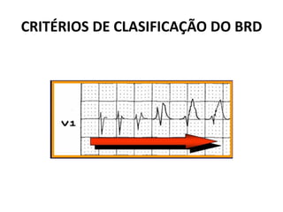 CRITÉRIOS DE CLASIFICAÇÃO DO BRD
 