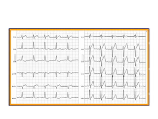 Bloqueios intraventriculares