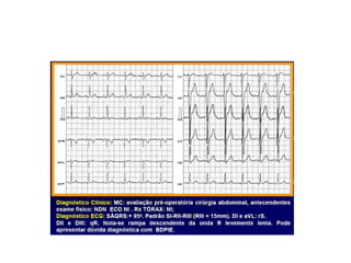 Bloqueios intraventriculares