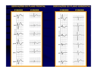 Bloqueios intraventriculares