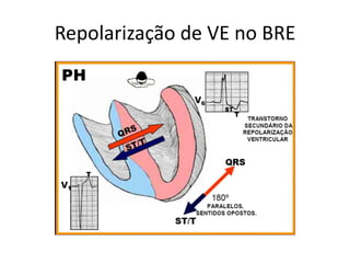 Repolarização de VE no BRE
 