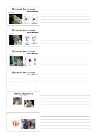 Bloqueios Anestésicos
Injeções Musculares
Masséter
Bloqueios Anestésicos
Injeções Musculares
E.C.M
Bloqueios Anestésicos
Injeções Musculares
Trapézio
Bloqueios Anestésicos
Injeções Articulares
Indicações terapêuticas e não diagnósticas
Aplicação de medicação intracapsular (corticosteróide, hialuronato de sódio, AL)
1. Localização Anatômica
Técnica Operatória
1. Localização Anatômica
 