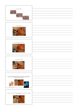 1. Localização Anatômica
1. Localização Anatômica
2. Assepsia da pele com PVPI tópico a 10%
3. Anestesia Tópica com Ice Spray
4. Anestesia local com inﬁltração intracapsular de 0,5 a 1ml de lidocaína 2% ou mepivacaína 3%
sem vaso constritor. Introdução da agulha no ponto marcado, de posterior para anterior,
atingindo o espaço supradiscal [???]
5. Inﬁltração de 1ml de hialuronato de sódio com seringa de 3ml e agulha 0,45 x 13mm ou agulha
0,7 x 25mm (22G)
 