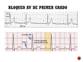Clase bloqueo auriculo ventriculares. ppt | PPTX