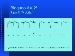 Bloqueo aurículo ventricular | PPT