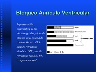 Bloqueo aurículo ventricular | PPT