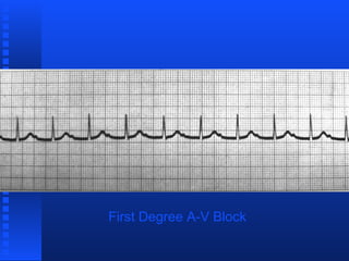 Bloqueo aurículo ventricular | PPT