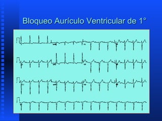 Bloqueo aurículo ventricular | PPT