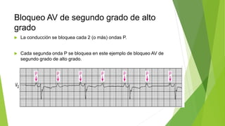 Bloqueo AV de segundo grado de alto
grado
 La conducción se bloquea cada 2 (o más) ondas P.
 Cada segunda onda P se bloquea en este ejemplo de bloqueo AV de
segundo grado de alto grado.
 