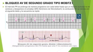  BLOQUEO AV DE SEGUNDO GRADO TIPO MOBITZ I
 El intervalo PR se prolonga de manera progresiva con cada latido hasta que un impulso auricular no se
conduce y desaparece el complejo QRS (fenómeno de Wenckebach); la conducción AV se reinicia con
el siguiente latido y la secuencia se repite.
 