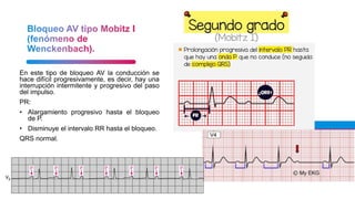 En este tipo de bloqueo AV la conducción se
hace difícil progresivamente, es decir, hay una
interrupción intermitente y progresivo del paso
del impulso.
PR:
• Alargamiento progresivo hasta el bloqueo
de P.
• Disminuye el intervalo RR hasta el bloqueo.
QRS normal.
 