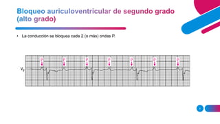 8
• La conducción se bloquea cada 2 (o más) ondas P.
 