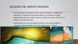 BLOQUEO DEL NERVIO MEDIANO
• Con el paciente en decúbito supino, brazo extendido y antebrazo en
supinación, se palpa la línea intercondílea y se introduce la aguja
perpendicularmente a la piel medial a la arteria humeral, a unos 2-3 cm
debajo de la línea del codo.
• Comenzamos con una intensidad inicial de 1 mA hasta localizar la
respuesta motora deseada a una intensidad menor a 0,5 mA.
 