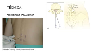 TÉCNICA
APROXIMACIÓN PARAMEDIANA
 