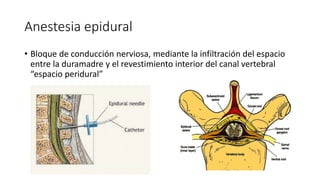 Anestesia epidural
• Bloque de conducción nerviosa, mediante la infiltración del espacio
entre la duramadre y el revestimiento interior del canal vertebral
“espacio peridural”
 