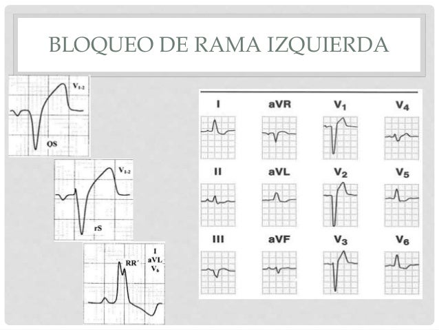Bloqueo de rama del haz de his