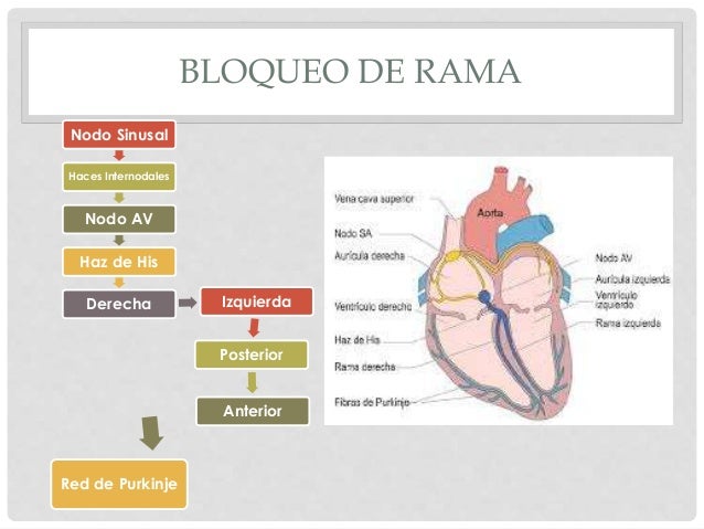 Bloqueo de rama del haz de his