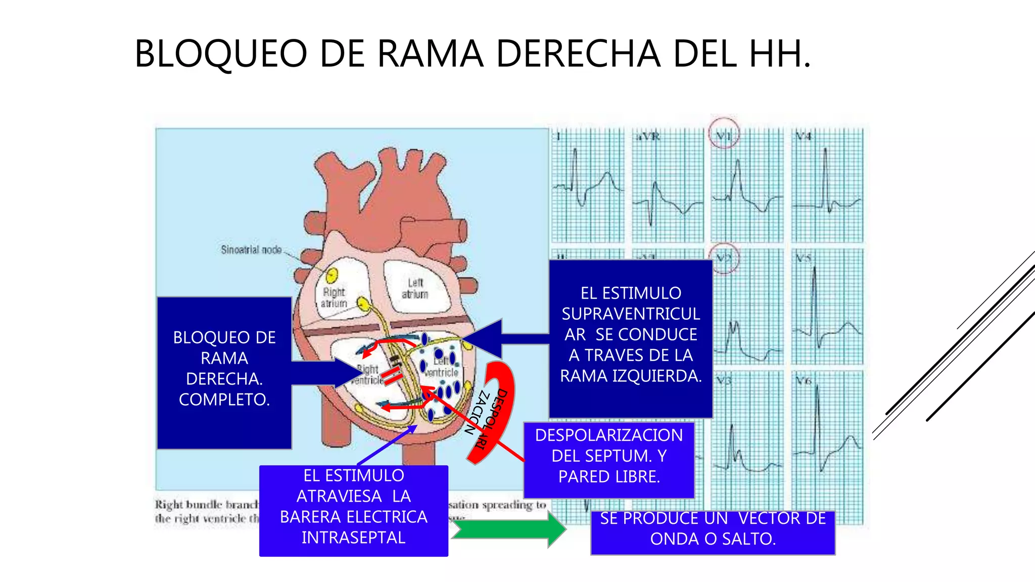 Rama R N Bloqueo de Rama | PPT