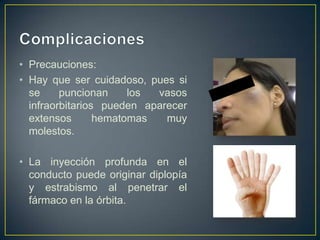 • Precauciones:
• Hay que ser cuidadoso, pues si
se puncionan los vasos
infraorbitarios pueden aparecer
extensos hematomas muy
molestos.
• La inyección profunda en el
conducto puede originar diplopía
y estrabismo al penetrar el
fármaco en la órbita.
 