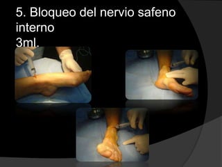 5. Bloqueo del nervio safeno
interno
3ml.

 