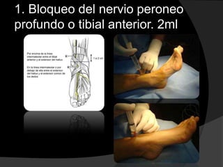 1. Bloqueo del nervio peroneo
profundo o tibial anterior. 2ml

 