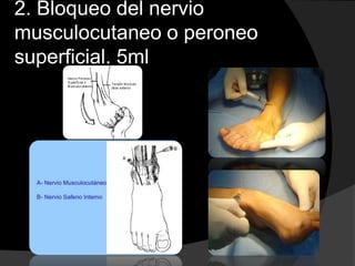 2. Bloqueo del nervio
musculocutaneo o peroneo
superficial. 5ml

 
