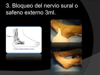 3. Bloqueo del nervio sural o
safeno externo 3ml.

 