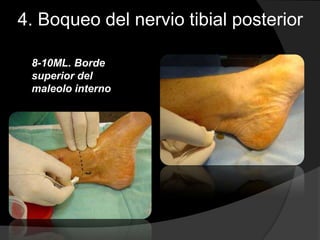 4. Boqueo del nervio tibial posterior
8-10ML. Borde
superior del
maleolo interno

 