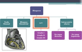 Bloqueos
Nodo
Sinusal
Bloqueo
Sinoatrial
A-V
Grado I
Grado II
Grado III
Intraventric
ulares
De rama
derecha
De rama
izquierda
 