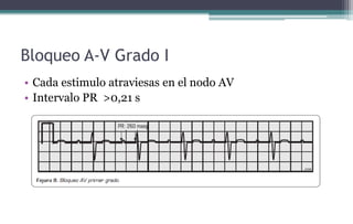 Bloqueo A-V Grado I
• Cada estimulo atraviesas en el nodo AV
• Intervalo PR >0,21 s
 