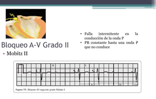 Bloqueo A-V Grado II
• Mobitz II
• Falla intermitente en la
conducción de la onda P
• PR constante hasta una onda P
que no conduce
 