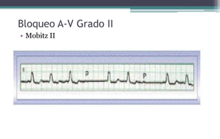Bloqueo A-V Grado II
• Mobitz II
 