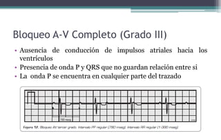 Bloqueo A-V Completo (Grado III)
• Ausencia de conducción de impulsos atriales hacia los
ventrículos
• Presencia de onda P y QRS que no guardan relación entre si
• La onda P se encuentra en cualquier parte del trazado
 