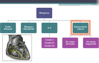 Bloqueos
Nodo
Sinusal
Bloqueo
Sinoatrial
A-V
Grado I
Grado II
Grado III
Intraventric
ulares
De rama
derecha
De rama
izquierda
 