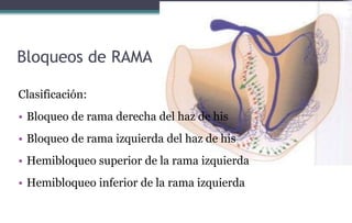 Bloqueos de RAMA
Clasificación:
• Bloqueo de rama derecha del haz de his
• Bloqueo de rama izquierda del haz de his
• Hemibloqueo superior de la rama izquierda
• Hemibloqueo inferior de la rama izquierda
 