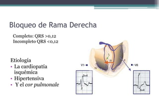 Bloqueo de Rama Derecha
Etiología
• La cardiopatía
isquémica
• Hipertensiva
• Y el cor pulmonale
Completo: QRS >0,12
Incompleto QRS <0,12
 