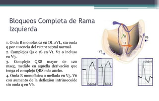 Bloqueos Completa de Rama
Izquierda
1. Onda R monofásica en DI, aVL, sin onda
q por ausencia del vector septal normal.
2. Complejos Qs o rS en V1, V2 o incluso
en V3.
3. Complejo QRS mayor de 120
mseg, medido en aquella derivación que
tenga el complejo QRS más ancho.
4. Onda R monofásica o mellada en V5, V6
con aumento de la deflexión intrinsecoide
sin onda q en V6.
 